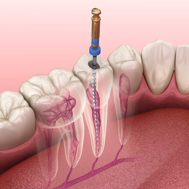 root canal treatment in Germany